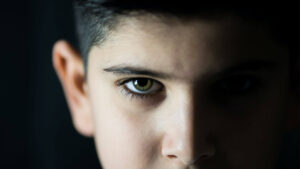 Pálpebra Caída - Fisioterapia - Tratamentos